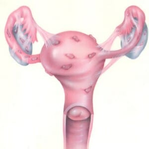Endometriose do útero: o que é, quão perigoso é, sintomas, sinais e tratamento em uma linguagem acessível. Como reconhecer os sintomas da endometriose uterina?