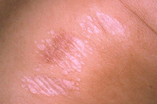 Eczema: causes, symptoms, types and treatment of eczema. How to treat eczema on the hands: treatment with ointments, drugs, folk remedies