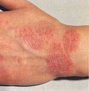 Eczema: causes, symptoms, types and treatment of eczema. How to treat eczema on the hands: treatment with ointments, drugs, folk remedies