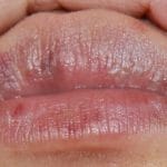 Schönheit erfordert Opfer: Ist es schmerzhaft, die Lippen mit Hyaluronsäure zu stechen? Empfehlungen für die Lippenpflege nach Augmentation und was nicht zu tun ist