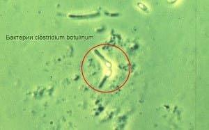 Botulisme - symptômes et traitement. Botulisme. Symptômes et signes d'empoisonnement. Causes, agent causal et toxines du botulisme. Diagnostic, traitement et prévention du botulisme.
