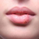 An overview of the best cold sore remedies. Herself a doctor: how to quickly cure a cold on the lip