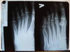Gamba piegata: un secondo di dolore e settimane di lungo recupero. Come tratti le lesioni da torsione delle gambe?