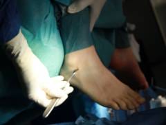 Gamba piegata: un secondo di dolore e settimane di lungo recupero. Come tratti le lesioni da torsione delle gambe?