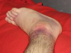Gamba piegata: un secondo di dolore e settimane di lungo recupero. Come tratti le lesioni da torsione delle gambe?
