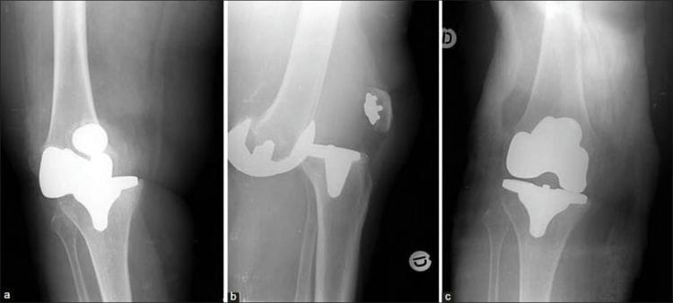 Causas de dolor en las piernas, tratamiento, enfermedades que causan dolor en las piernas. Las piernas duelen: causas, diagnóstico, tratamiento.
