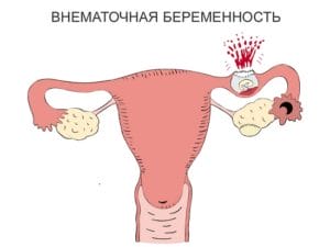 Dolor abdominal bajo en mujeres y hombres. Causas del dolor en la parte inferior del abdomen.