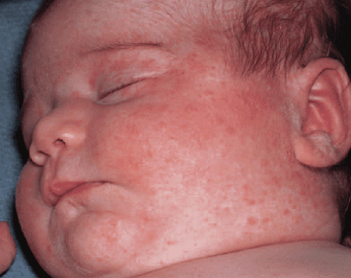 Allergy in children. Allergy treatment in children and adults: approaches and methods