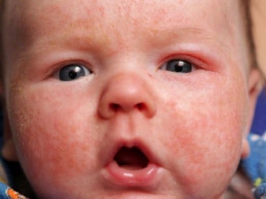 Allergy in children. Allergy treatment in children and adults: approaches and methods