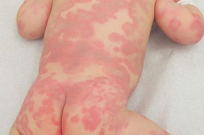 Allergy in children. Allergy treatment in children and adults: approaches and methods