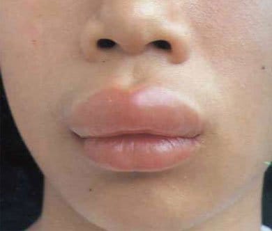 Allergy in children. Allergy treatment in children and adults: approaches and methods