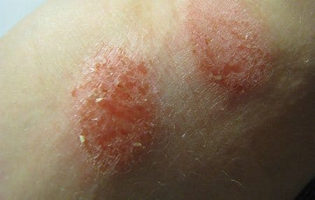 Allergy in children. Allergy treatment in children and adults: approaches and methods
