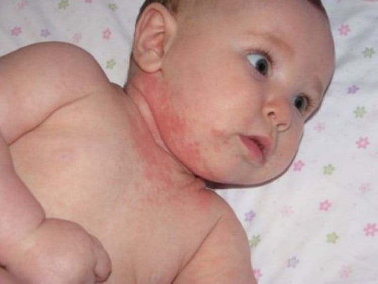 Allergy in children. Allergy treatment in children and adults: approaches and methods