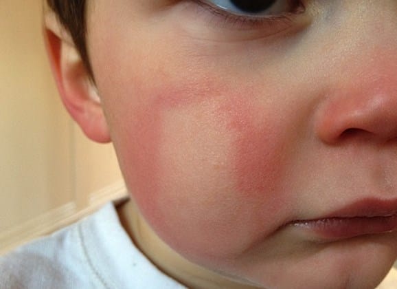 Allergy in children. Allergy treatment in children and adults: approaches and methods