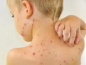 Allergy in children. Allergy treatment in children and adults: approaches and methods