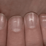 Manchas brancas nas unhas: por que aparecem, o que significa, como removê-las. O que significam os pontos brancos nas unhas?
