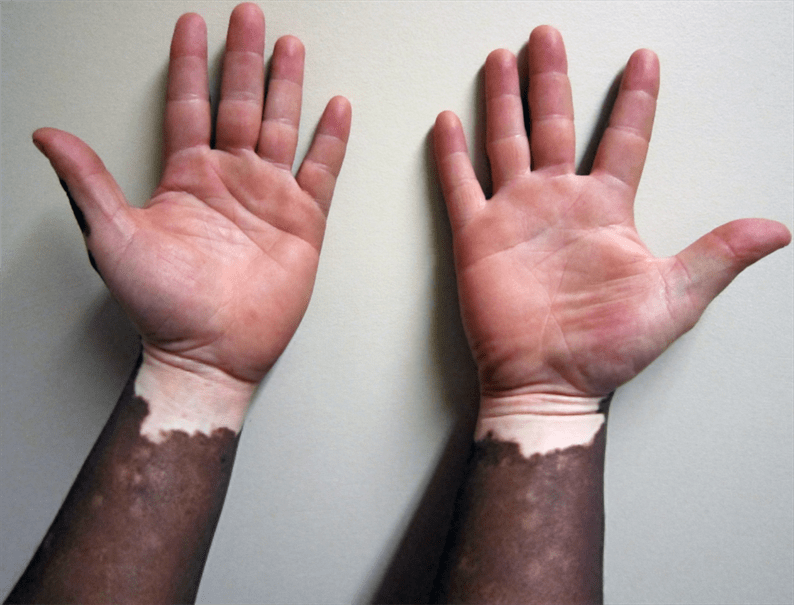 How to get rid of white spots / vitiligo?