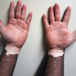 Wie weiße Hautflecken / Vitiligo loswerden?