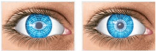 How does a person with astigmatism see? Correction with glasses and lenses. How people with astigmatism see