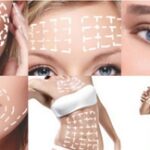 Caractéristiques de la procédure de lifting des fils avec des mésothreads 3D