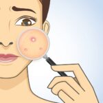 Acne treatment at a cosmetologist and at home