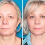 Омолодження особи після 50 років без операції