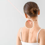 Removal of papillomas on the body: an overview of methods