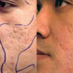 Características de la dermoabrasión facial mecánica y láser